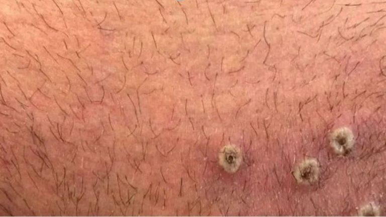Confirman dos nuevos casos de viruela símica