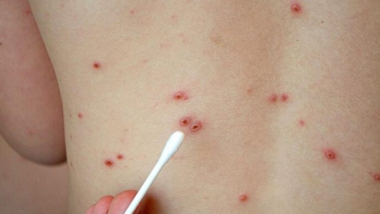 Suman 10 casos de sarampión Suman 10 casos de sarampión