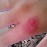 PICADURAS (3)